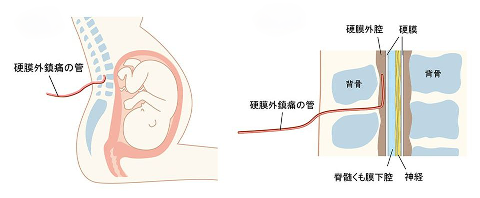 硬膜外鎮痛の管を背中に挿入する位置を示した図